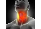 Early Signs and Symptoms of Thyroid Cancer You Should Not Ignore